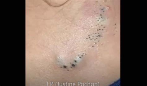 reddit popping|reddit blackheads and cysts videos.